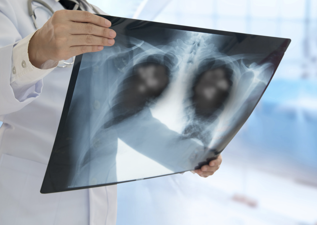 Pneumonia Pneumocystis jirovecii